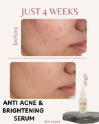 Anti acne & brightening serum