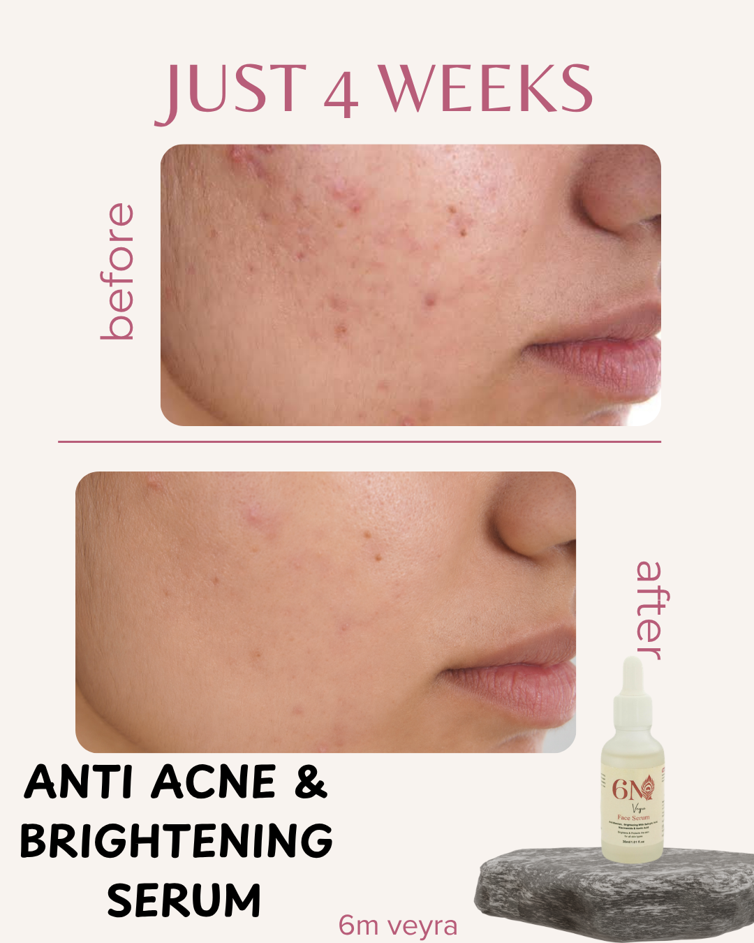 Anti acne & brightening serum