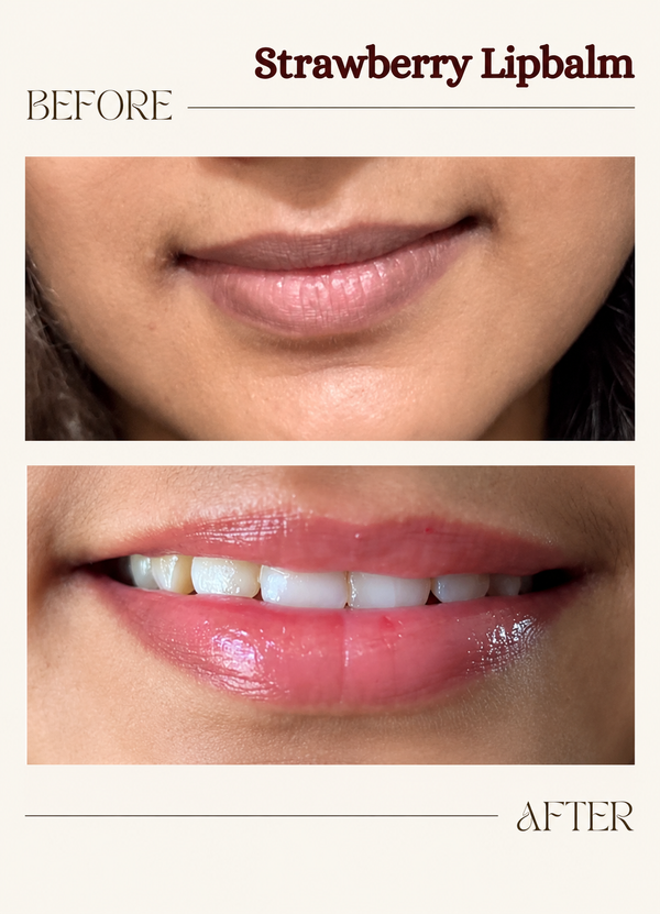 Visible improvement in acne breakouts and skin texture before and after Anti Acne Serum use