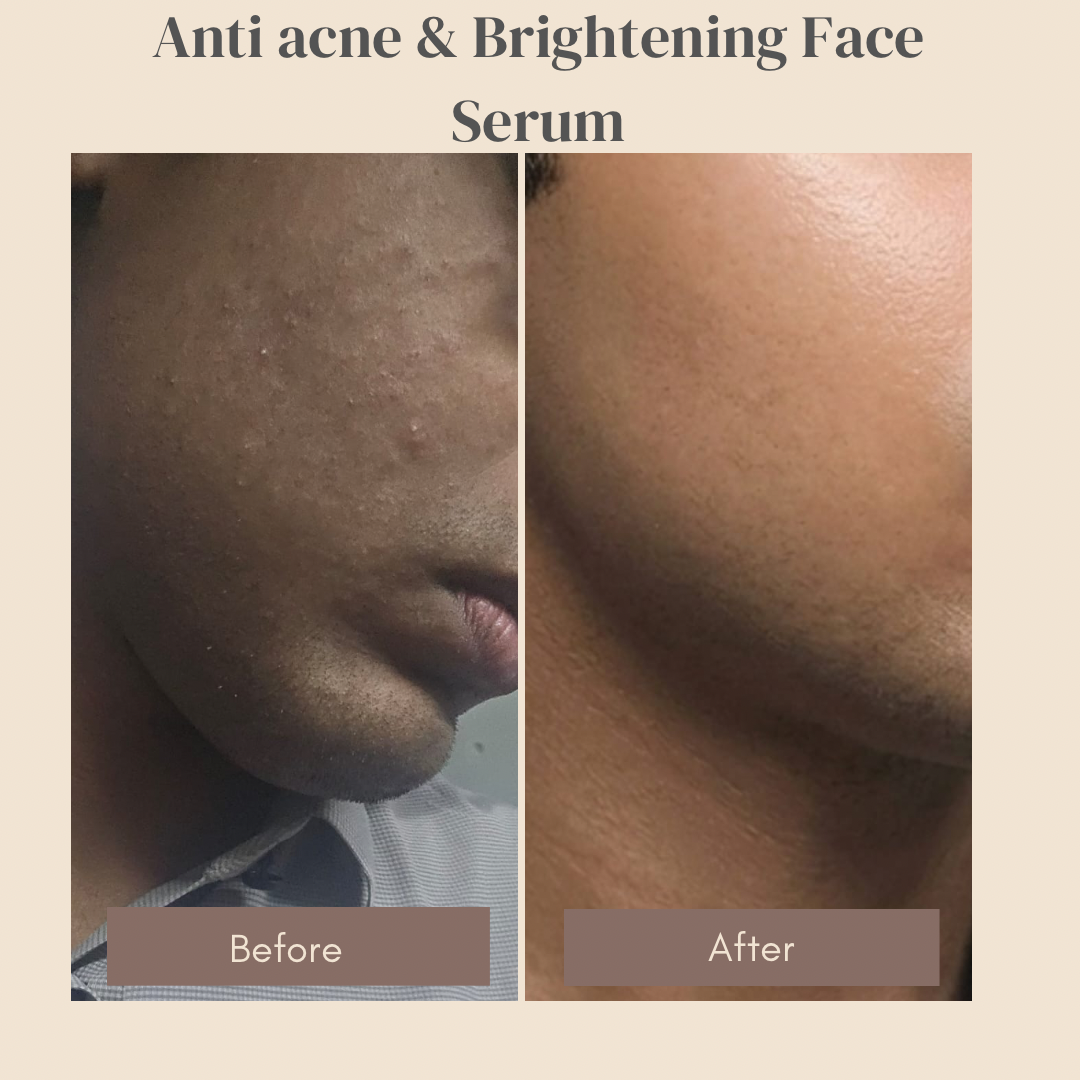 Clarifying Serum For Acne-Prone & Uneven Skin Before and After results