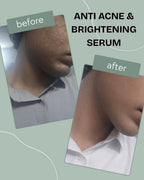 Anti acne & brightening serum
