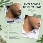 Application image for Clarifying Serum For Acne-Prone & Uneven Skin by 6M Veyra