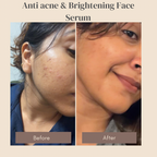 30ml bottle of 6M Veyra Anti Acne and Brightening Face Serum on clean display